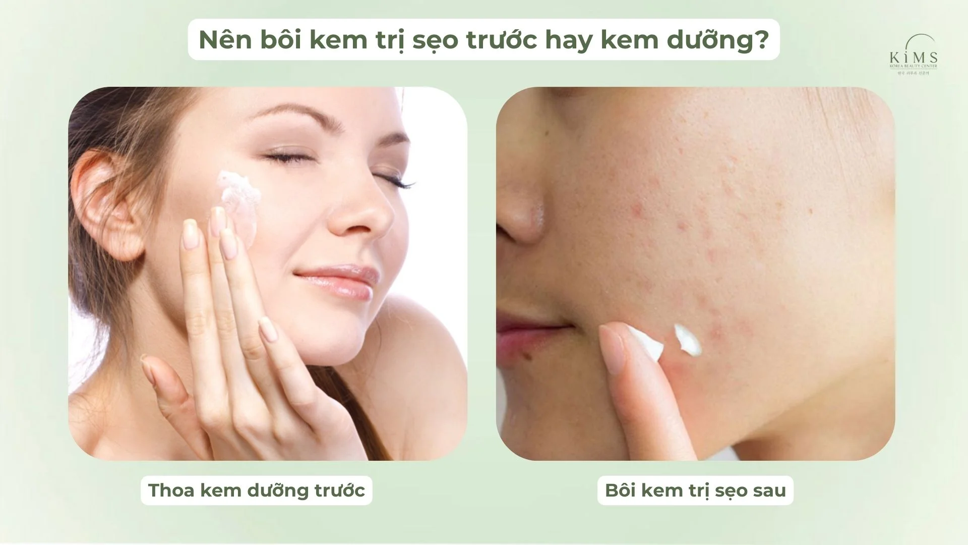Nên bôi kem trị sẹo trước hay kem dưỡng?