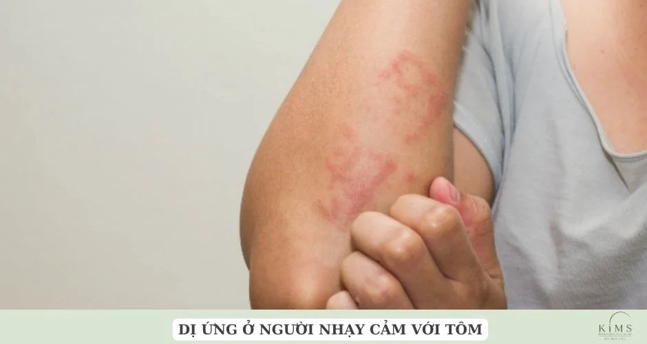 Cơ địa dị ứng tôm không nên ăn.