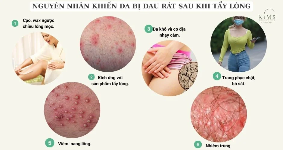 Nguyên nhân khiến da bị đau rát sau khi tẩy lông.