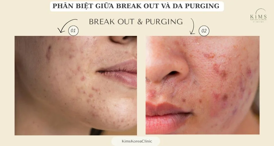 Mặt bị break out và da purging.