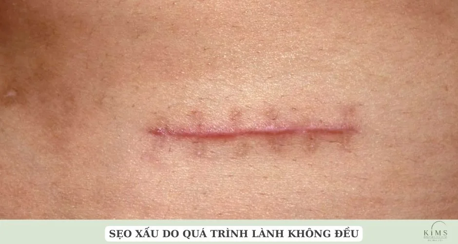 Sẹo xấu do lành không đều.