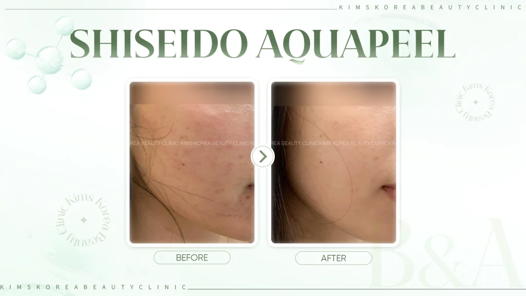 shiseido-aquapeel-hinh-2