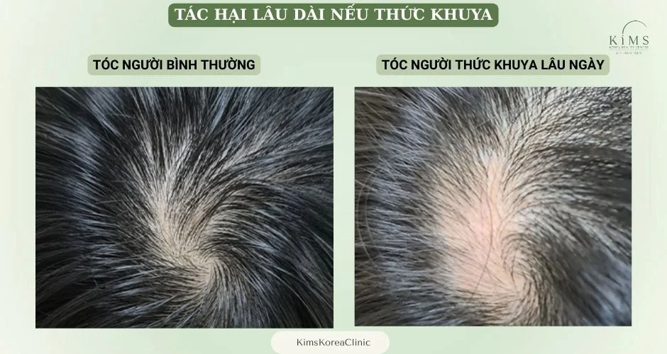 Thức khuya có hại cho tóc không.