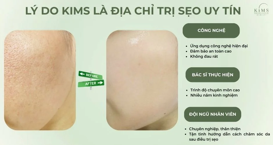 Điều trị sẹo lõm ở đâu uy tín và hiệu quả?