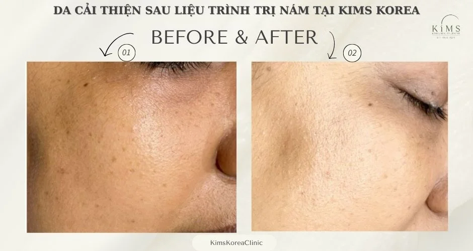Trước và sau liệu trình trị nám tại Kims.