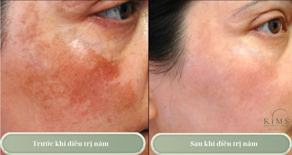 Trước và sau khi điều trị nám tại Kims Korea Clinic.