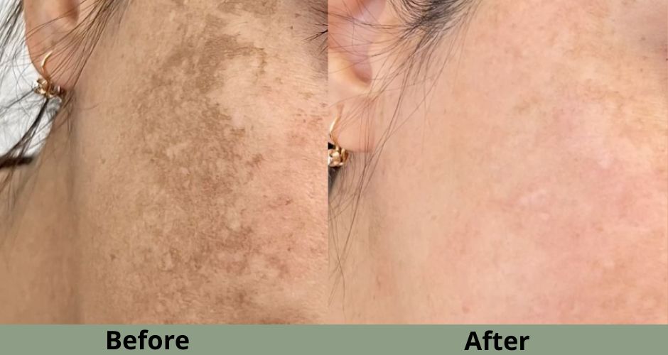 Trước và sau điều trị nám.