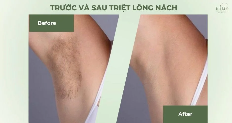 Triệt lông nách tận gốc không đau, không lo thâm tại Kims Korea