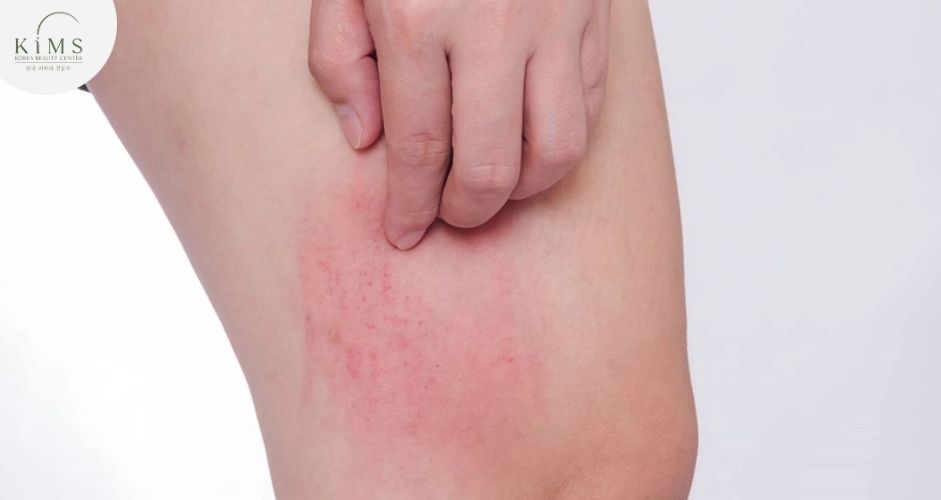 Da nhạy cảm có thể bị kích ứng sau khi triệt lông