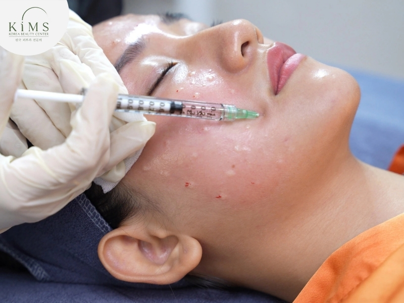 Tiêm hoạt chất vào da bằng kim tiêm siêu nhỏ.