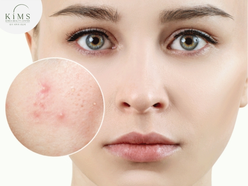Da mụn hoặc quá khô, có các vấn đề kích ứng, nhạy cảm cần được tư vấn từ chuyên gia