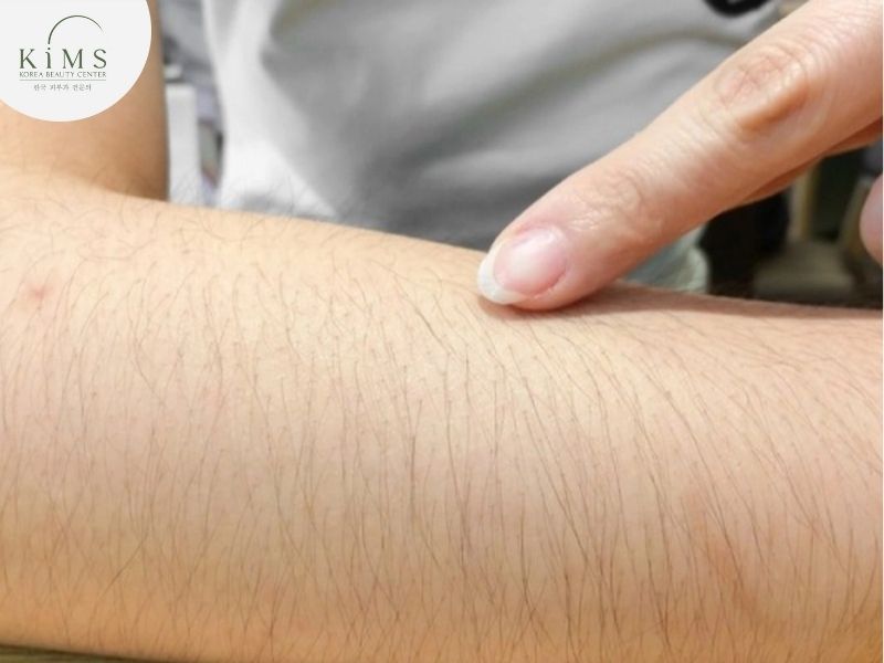 Phụ nữ có nhiều lông trên cơ thể là do nhiều nguyên nhân khác nhau