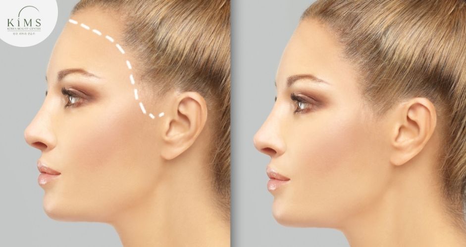 Cấy tóc là thủ thuật di chuyển nang tóc khỏe từ vùng cho đến vùng nhận