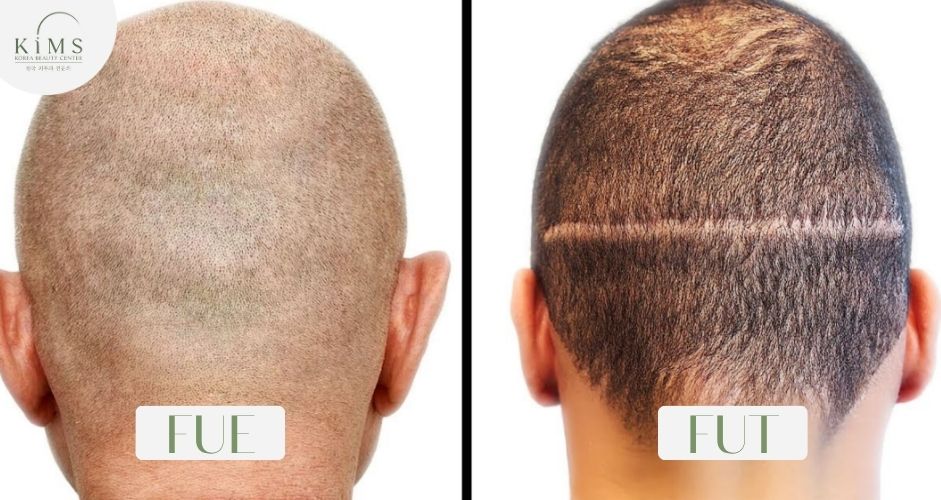 Phân biệt hai phương pháp cấy tóc giúp bạn lựa chọn chuẩn xác hơn cho mái tóc của bạn