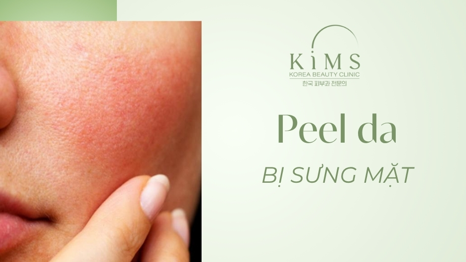 Peel da bị sưng mặt phải làm sao? Hướng dẫn xử lý khẩn cấp an toàn