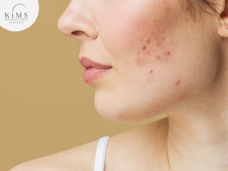 Hiện tượng đẩy mụn là một phản ứng tích cực sau khi peel da.