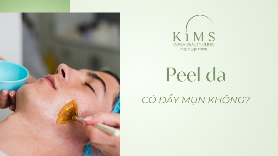 Peel da có đẩy mụn không? Kéo dài bao lâu và cách xử lý thế nào?