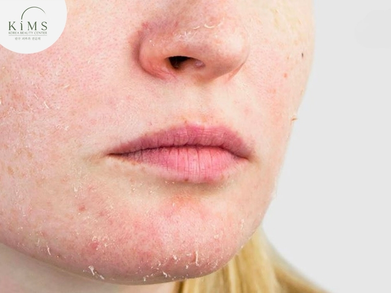 Da bong tróc nhẹ là một phản ứng tự nhiên sau khi peel.