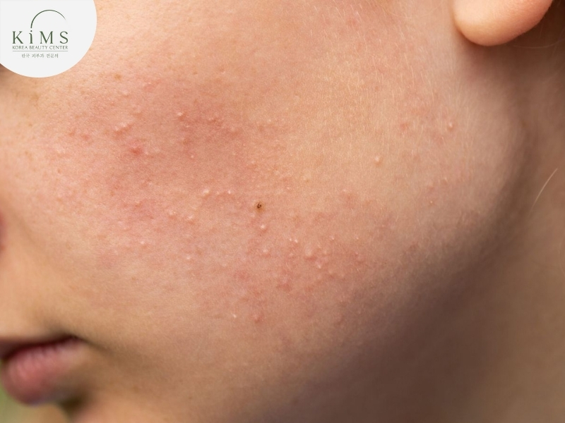 Nổi mụn nước hoặc mụn mủ là dấu hiệu nhiễm trùng cần chú ý.