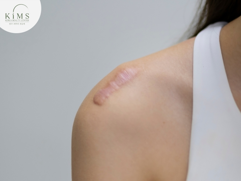 Sẹo lồi lành tính nhưng gây ảnh hưởng lớn đến yếu tố thẩm mỹ.