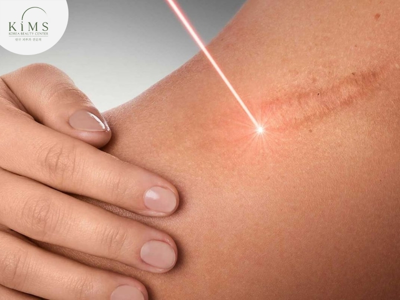 Công nghệ laser hiện đại giúp cải thiện màu sắc và bề mặt sẹo.