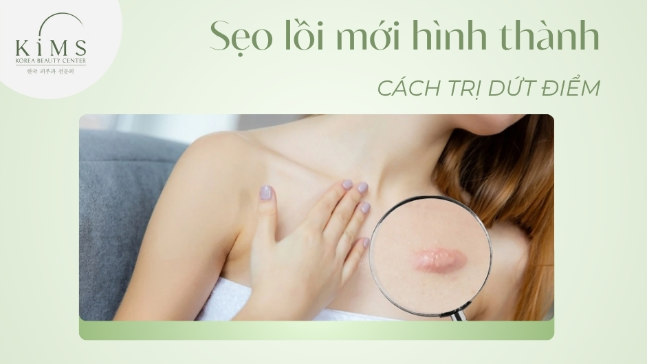 Trị sẹo lồi mới hình thành: Cách trị dứt điểm, ngăn tái phát
