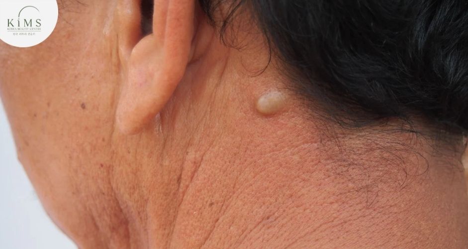 U bã đậu là một dạng u lành tính phổ biến trên da do nhiều nguyên nhân gây ra