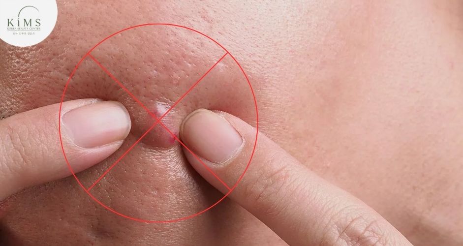 Biến chứng nguy hiểm nếu tự ý nặn tại nhà và không điều trị y tế kịp thời