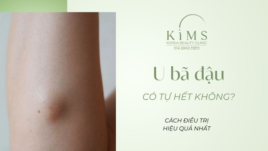 U bã đậu có tự hết không? Cách điều trị hiệu quả nhất