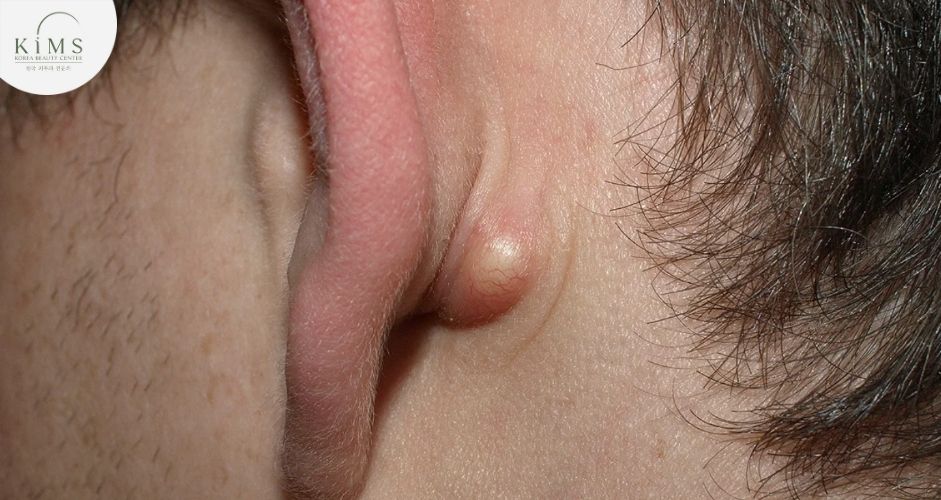 Khối u bã đậu sau tai có thể lớn dần và gây khó chịu