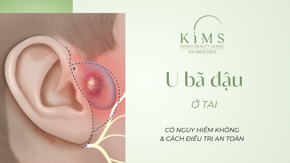 U bã đậu ở tai: Có nguy hiểm không & Cách điều trị an toàn
